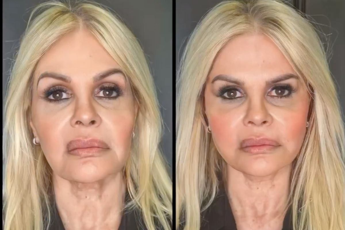 Harmonização facial de Monique Evans
