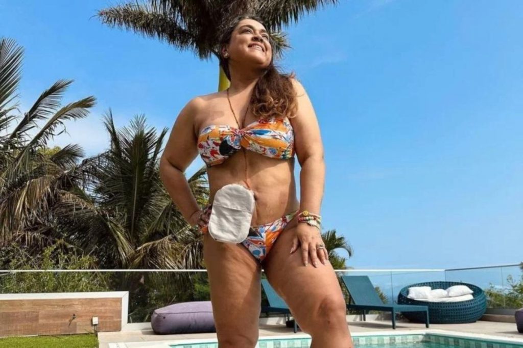 Preta Gil de biquíni, mostra sua bolsa de ileostomia