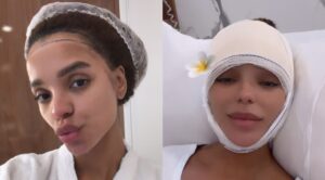Brunna Gonçalves surpreende e faz cirurgia plástica para diminuir tamanho da testa