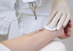 Remover ou cobrir? Saiba como funciona o processo para apagar tatuagens e o que mais dói