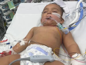 Bebê confunde soda cáustica com leite e perde metade da língua