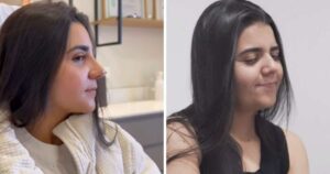 Yasmin Santos se choca com resultado de rinoplastia: ‘Ainda está bem inchado’