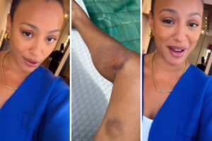 Sheron Menezzes cai de bicicleta e exibe hematomas