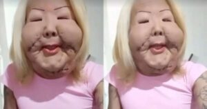 Com o rosto deformado, famosa passa por cirurgia para retirar óleo mineral da face