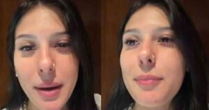 É grave? Ana Castela surpreende ao revelar diagnóstico: ‘Tá meio feio’