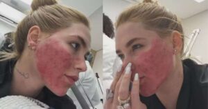 Especialista faz alerta após Virginia surgir com rosto em carne viva: ‘Deve evoluir’