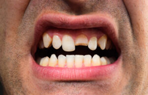 Mulher quebra dente do namorado ao descobrir fotos da filha de calcinha em celular