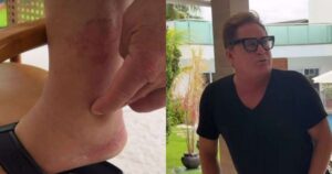 Leonardo diverte a web ao culpar ‘cachaça’ por pé inchado e dá resposta sincerona a Poliana