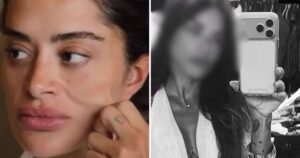 Ex-BBB Aline Campos faz mais uma cirurgia plástica e mostra resultado: ‘Fluido’