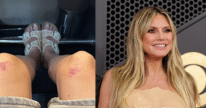 Heidi Klum posta foto de machucados após usar roupa moldada no Grammy 2026