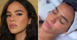 Laser na boca? O segredo por trás do novo procedimento estético de Bruna Marquezine
