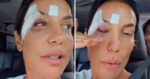 Ivete Sangalo surge com o rosto cheio de hematomas após internação: ‘É difícil’