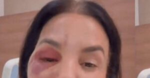 Ivete Sangalo passa por cirurgia após sofrer fraturas no rosto em acidente doméstico