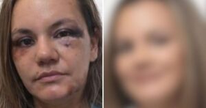 Mulher que sofreu 60 socos passa por reconstrução facial e especialista alerta: ‘Múltiplos impactos’