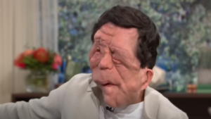 Ator Adam Pearson chama atenção e aumenta interesse sobre a neurofibromatose