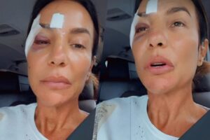 Ivete surge em carro após bater a cabeça: “Foi bem agudo”