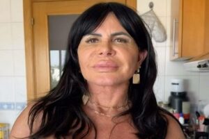 Gretchen surge careca e expõe drama de tratamento: ‘Destruiu’