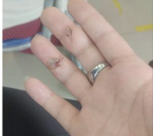 Mulher recebe mordida brutal de moradora em situação de rua; VEJA VÍDEO!