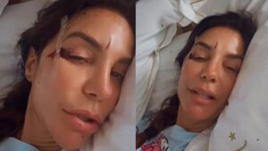 No hospital, Ivete Sangalo surge com o rosto machucado e revela o que aconteceu: ‘Que susto’