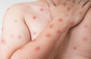 Ministério da Saúde confirma números de casos de mpox no Brasil