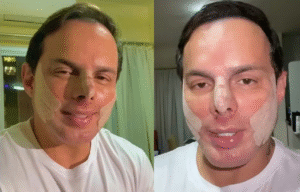 Marido de Gretchen faz novo procedimento no nariz e mostra resultado; veja o antes e depois