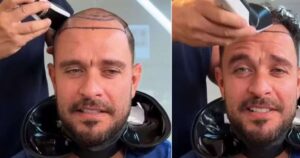 Diogo Nogueira raspa o cabelo e levanta suspeita de novo transplante capilar; especialista detalha procedimento, cada vez mais popular em famosos: ‘Deixou de ser tabu’