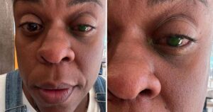 Cega? Cacau Protásio tem perda de visão após usar produto: ‘Dor desesperadora’