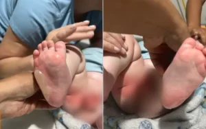 Bebê sofre queimaduras graves em berçário no interior de Goiás; veja