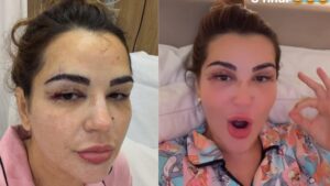 Deolane aparece com hematomas no rosto após e assusta a web