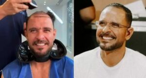 Diogo Nogueira raspa o cabelo e levanta suspeitas sobre possível transplante capilar
