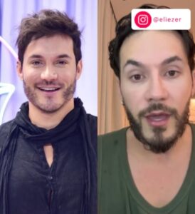 Rodrigo Sant’Anna, Eliezer… Veja os famosos que retiraram a harmonização facial