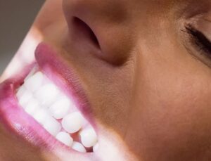 Anvisa determina recolhimento de fitas de clareamento dental; saiba o motivo!