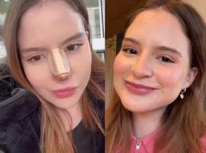 Sophia Valverde mostra resultado de cirurgia no nariz; veja o antes e depois