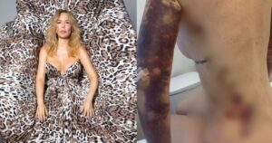 Após dezenas de cirurgias e R$ 500 mil gastos, Ju Isen revela tratar dismorfia há mais de um ano